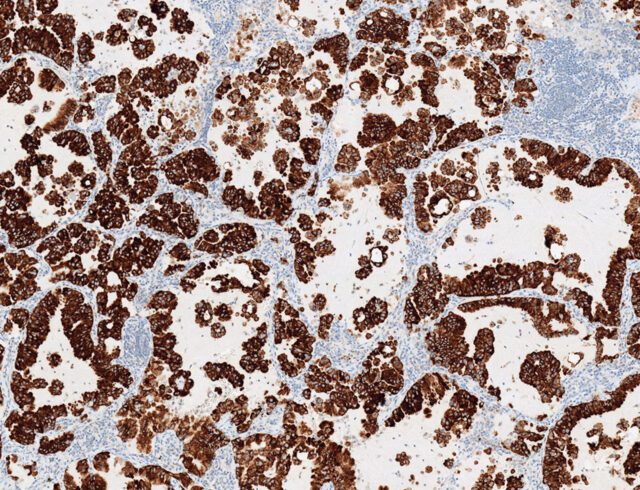 VENTANA-ALK-D5F3-CDx-Assay